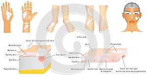 Vitiligo photo