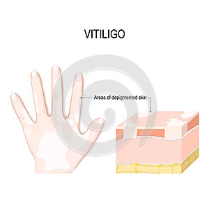 Vitiligo. Is a skin condition characterized by portions of the skin losing their pigment photo