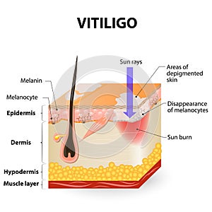Vitiligo photo