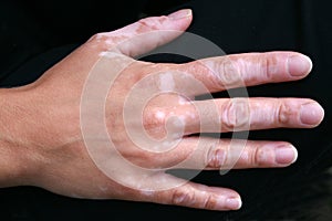 Vitiligo skin condition on hand