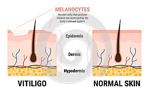 Vitiligo skin disease and healthy skin infographic. Melanocytes stop producing melanin. Skin anatomy. Flat vector illustration photo