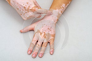 Vitiligo on the skin of hands. Finger indicates skin defect photo