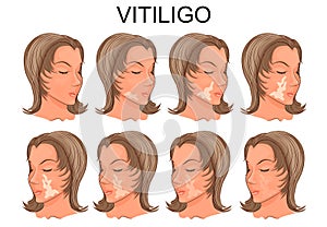 Vitiligo treatment. before and after photo