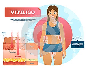 Vitiligo vector illustration. White pigment autoimmune disease with pigment loss. photo