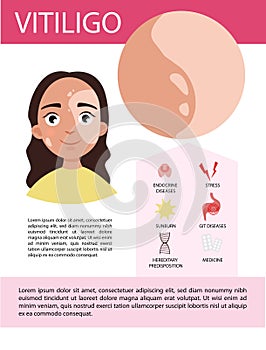 Vitiligo vector infographics.