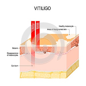 Vitiligo photo