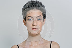 Vitiligo woman beauty portrait