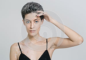 Vitiligo woman beauty portrait