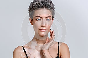 Vitiligo woman beauty portrait