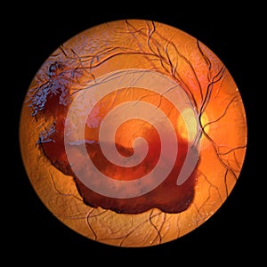 Vitreous hemorrhage as observed during ophthalmoscopy, 3D illustration photo