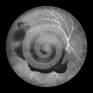 Vitreous hemorrhage as observed during ophthalmoscopy, illustration photo