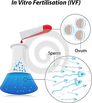 In Vitro Fertilisation photo