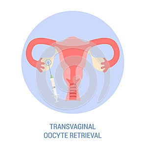 In vitro fertilisation step. Removing oocyte from the ovary