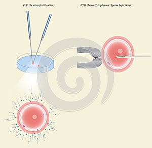In vitro fertilization