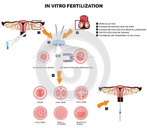 In vitro fertilization photo
