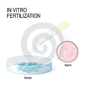In vitro fertilization. artificial insemination photo