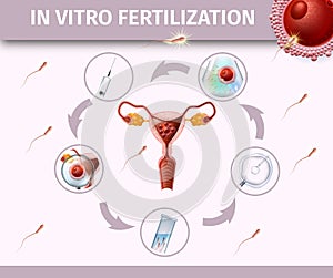 In Vitro Fertilization Colored Poster with Uterus