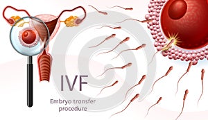 In Vitro Fertilization. Embryo Transfer Procedure