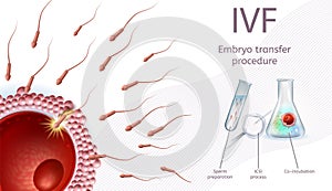 In Vitro Fertilization Embryo Transfer Procedure. photo