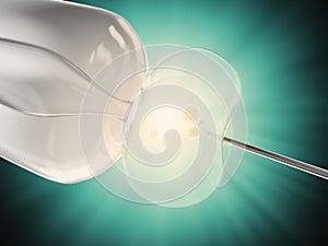 In vitro fertilization