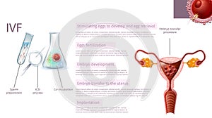 In Vitro Fertilization Stages. Medical Banner. photo