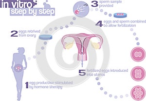 In vitro fertilization step by step