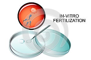 In-vitro fertilization. photo