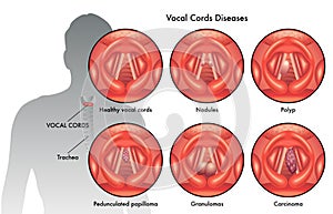 Vocal cord diseases