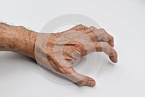 Volkmannâ€™s contracture in Southeast Asian old man