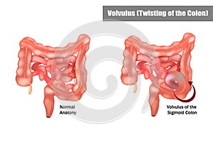 Volvulus of the Sigmoid Colon