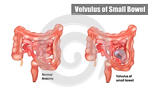 Volvulus of Small Bowel. Vector illustration