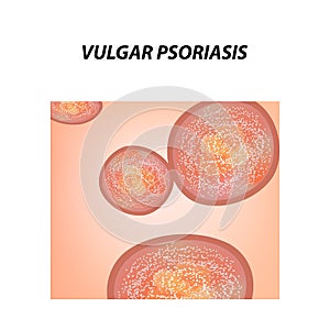 Vulgar psoriasis. Not pustular type of psoriasis. Eczema, skin disease dermatitis. Infographics. Vector illustration on photo