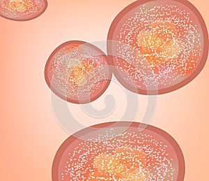 Vulgar psoriasis. Not pustular type psoriasis texture. Eczema, skin disease dermatitis. Infographics. Vector