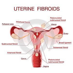 Vulvovaginal candidiasis or vaginal yeast infection.Vector illustration