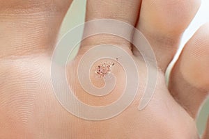 Wart on a blunt close-up. Macro shot of human papilloma on the foot