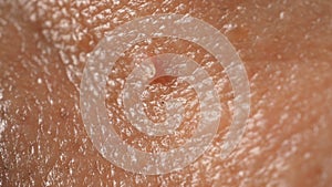 Wart on face. Macro shot of wart near eye. Papilloma on skin photo