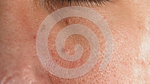 Wart on face. Macro shot of wart near eye. Papilloma on skin photo