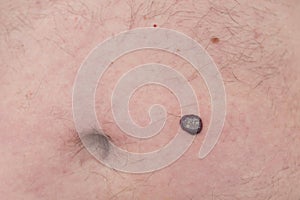 Wart - growth and swelling skin wart photo