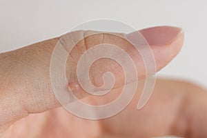 Wart on hand. The concept of treating warts and other skin defects. Close-up of a wart on a finger, a benign growth on