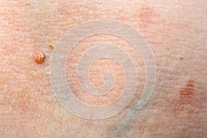 Wart on human skin