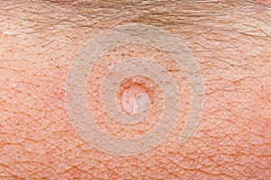 Wart on human skin