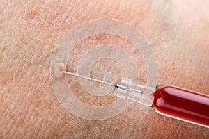 Wart injection treatment
