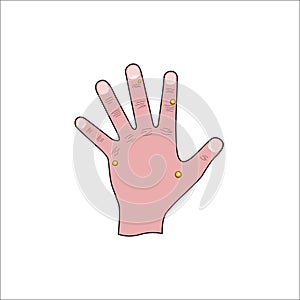 Wart removal medical illustration, human left hand affected by papilloma virus