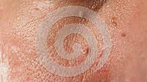 Wart skin removal. Macro shot of warts near eye on face photo