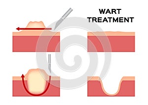 Wart treatment . remove it from skin by surgery callus