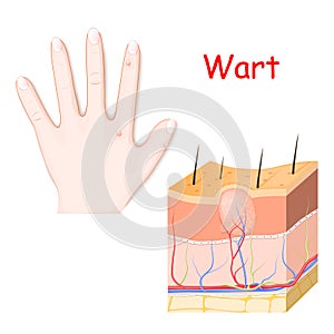 Warts on a hand. cross section of detailed wart