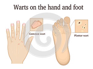 Warts on the hand and foot photo
