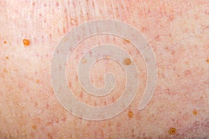 Warts on human skin