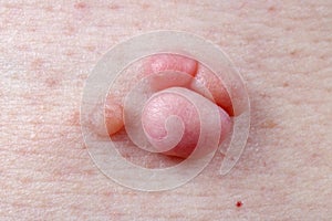 Warts, polyps and moles grow on human skin all their life