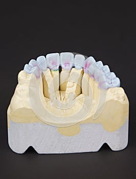 wax denture